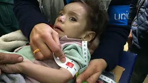 Syrie-Krieg: Schwer mangelernährtes Mädchen in Madaya