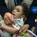 Syrie-Krieg: Schwer mangelernährtes Mädchen in Madaya