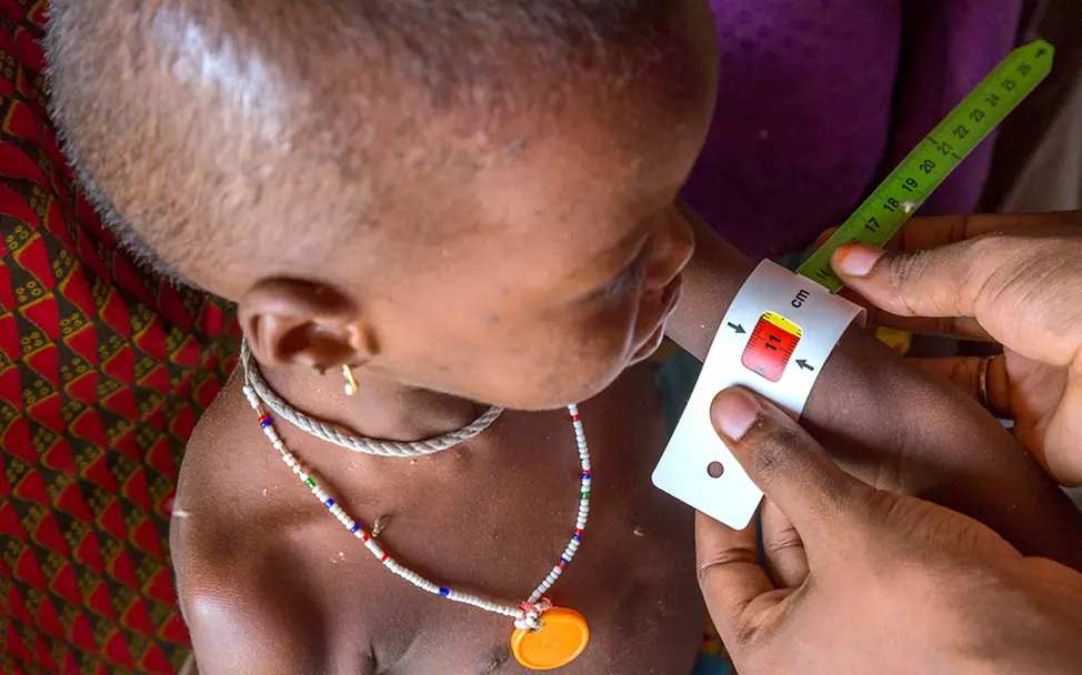 Ein Mädchen in Nigeria wird auf akute Mangelernährung untersucht | © UNICEF/Esiebo Spendenaufruf Bundespräsident Steinmeier: Mädchen wird auf akute Mangelernährung untersucht