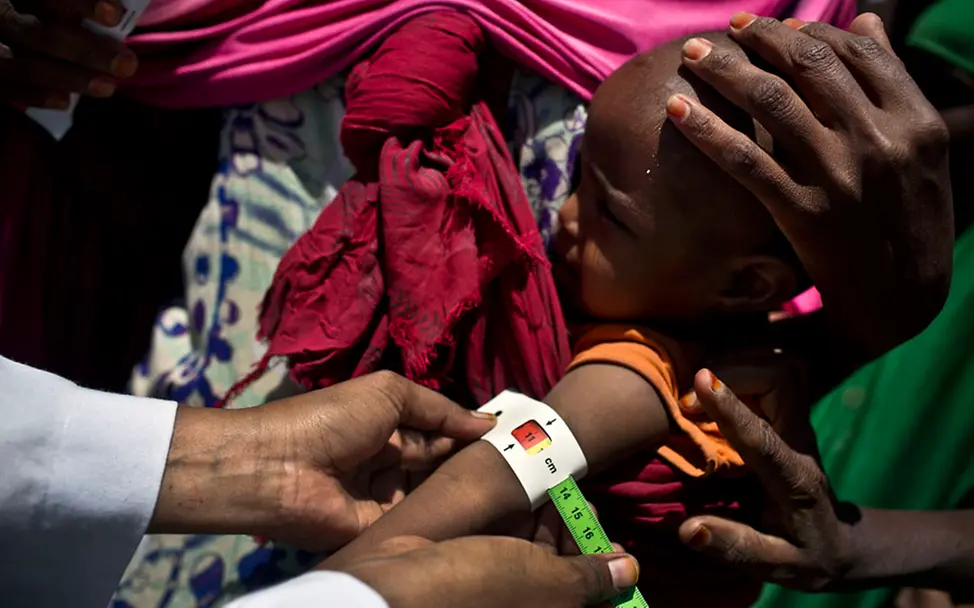 Somalia: Der Grad der Mangelernährung wird bei einem Kind gemessen. | © UNICEF/Holt Somalia: Der Grad der Mangelernährung wird bei einem Kind gemessen.