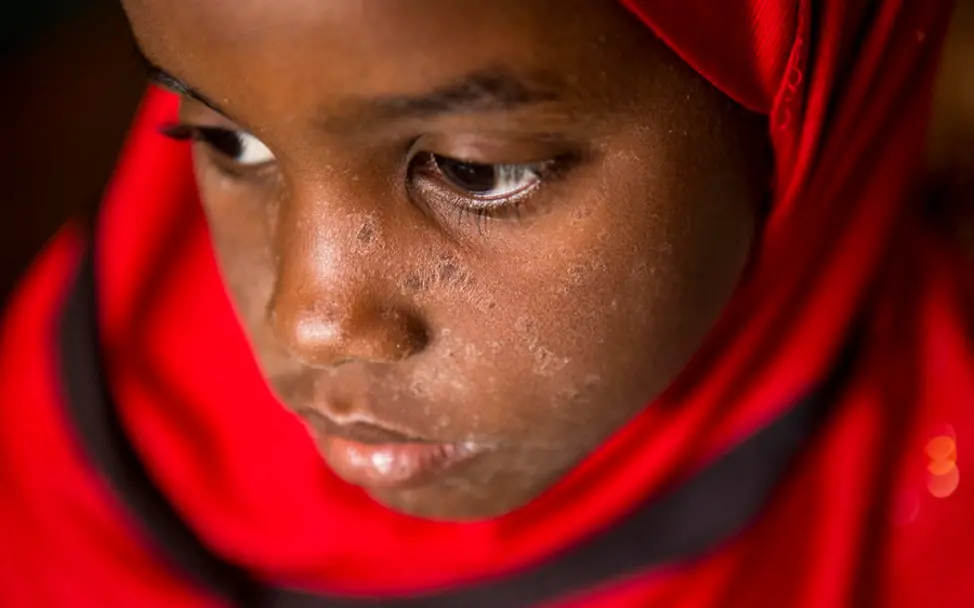 Die siebenjährige Hourouki ist an Masern erkrankt | © UNICEF/UN0293812/Keïta Mali: Das siebenjährige Mädchen ist an Masern erkrankt