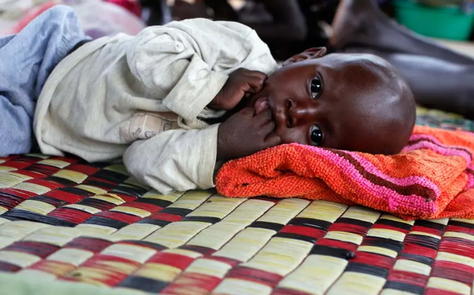 Hungersnot Afrika verhindern: Schwer mangelernährte Kinder sind vom Hungertod bedroht. Hilfsorganisationen wie UNICEF helfen. 