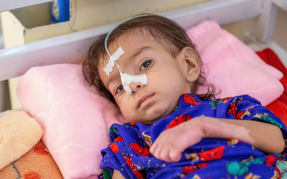 Afghanistan: Ein mangelernährtes Mädchen wird über eine Sonde ernährt | © UNICEF/Bidel Afghanistan: Ein mangelernährtes Mädchen wird über eine Sonde ernährt