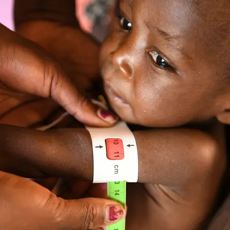 Malawi: Bei einem Kind wird der Armumfang gemessen | © Thoko Chikondi/UNICEF Malawi: Bei einem Kind wird der Armumfang gemessen