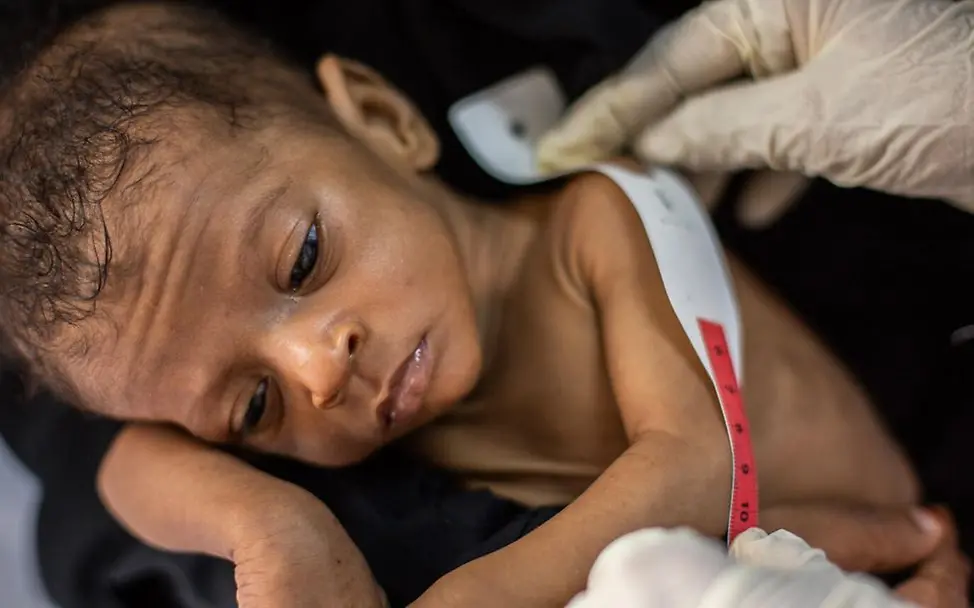 Die sieben Monate alte Rajwa aus dem Jemen leidet an Mangelernährung. | © UNICEF/Al-Haj Ein schwer mangelernährtes Kind wird vermessen.