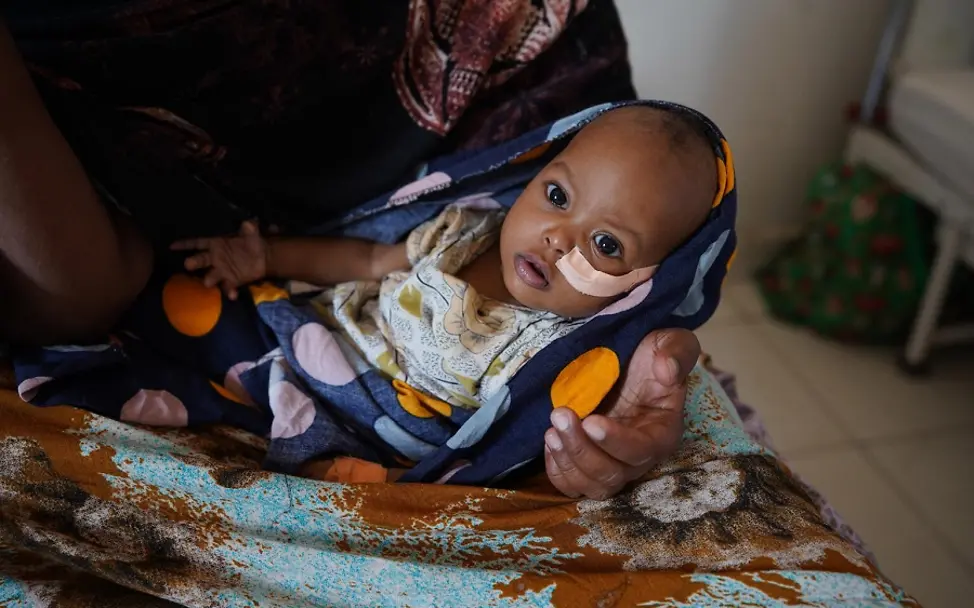 Somalia: Baby bekommt über eine Sonde Nahrung.