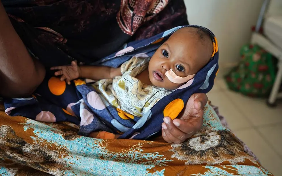 Ein mangelernährtes Baby in Somalia wird behandelt. | © UNICEF/Sewunet Drohende Hungersnot Somalia: Hunderttausende Kinder sind schwer mangelernährt und brauchen humanitäre Hilfe.