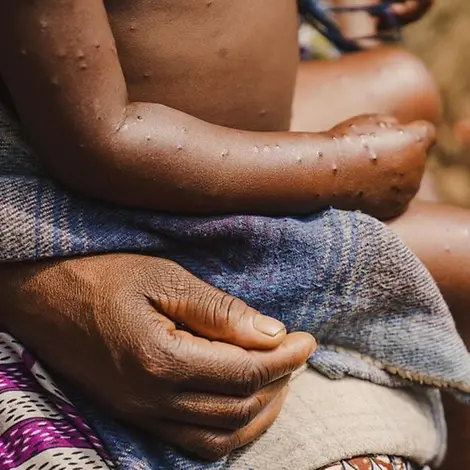 Mpox Virus: Ein erkranktes Kind auf dem Arm seiner Mutter | © UNICEF/Benekire Mpox Virus: Ein erkranktes Kind auf dem Arm seiner Mutter