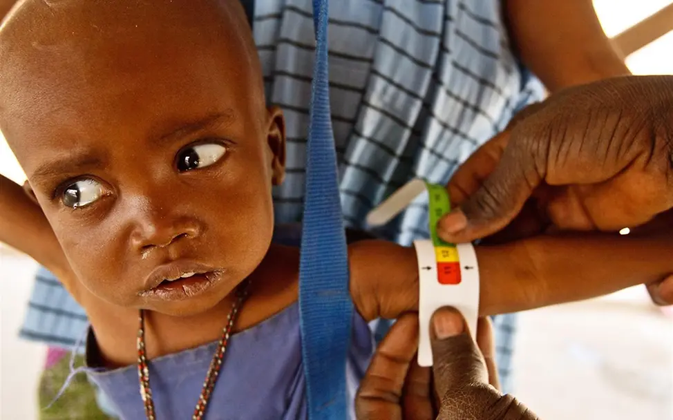 Kind wird auf Mangelernährung untersucht. ©UNICEF/Asselin