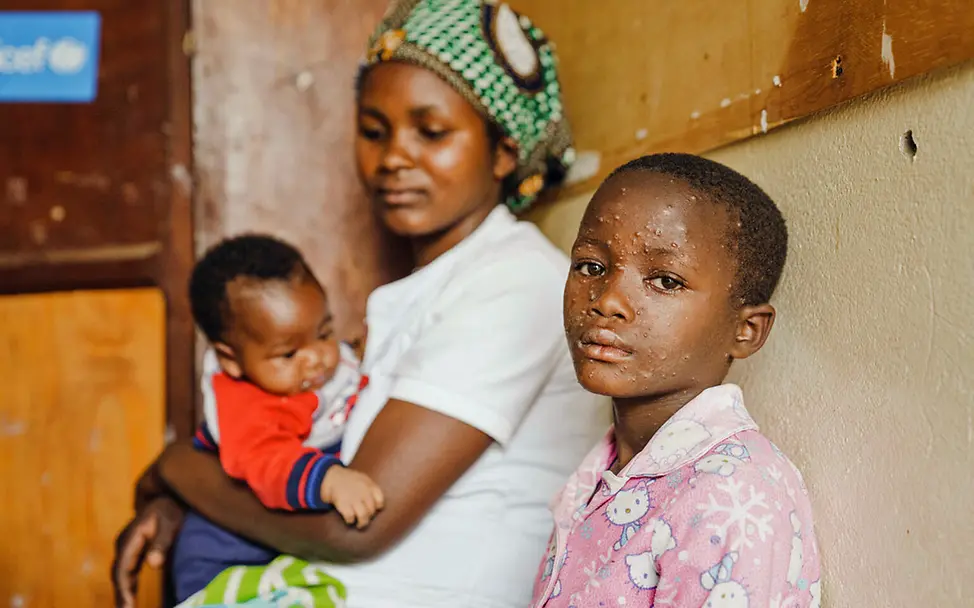 Demokratische Republik Kongo Nothilfe: Ein an Mpox erkranktes Mädchen wartet in einem Gesundheitszentrum auf ihre Behandlung