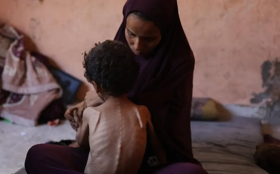 Der zweijährige Yazan ist schwer mangelernährt.