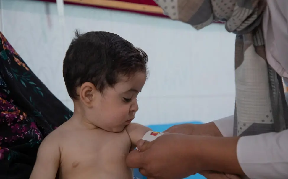 Afghanistan: Ein Mädchen wird wegen ihrer Mangelernährung untersucht.