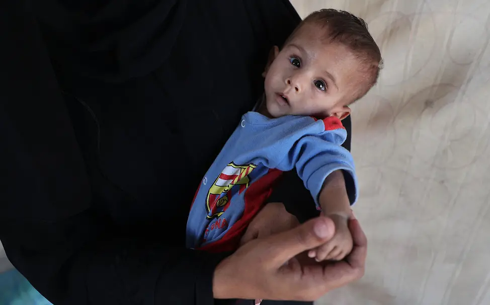 Kinder Gaza: Ali (2) leidet anr Mangelernährung.