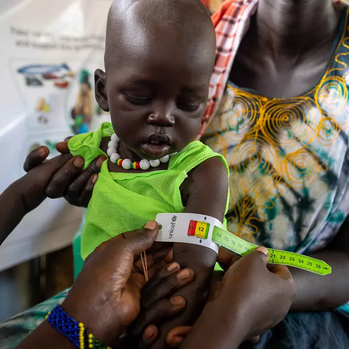 Hunger im Südsudan: Hunderttausende Kinder im Südsudan haben nicht genug zu essen.| © UNICEF/Prinsloo Südsudan Hungerkrise: Ein Kleinkind wird auf Mangelernährung untersucht.
