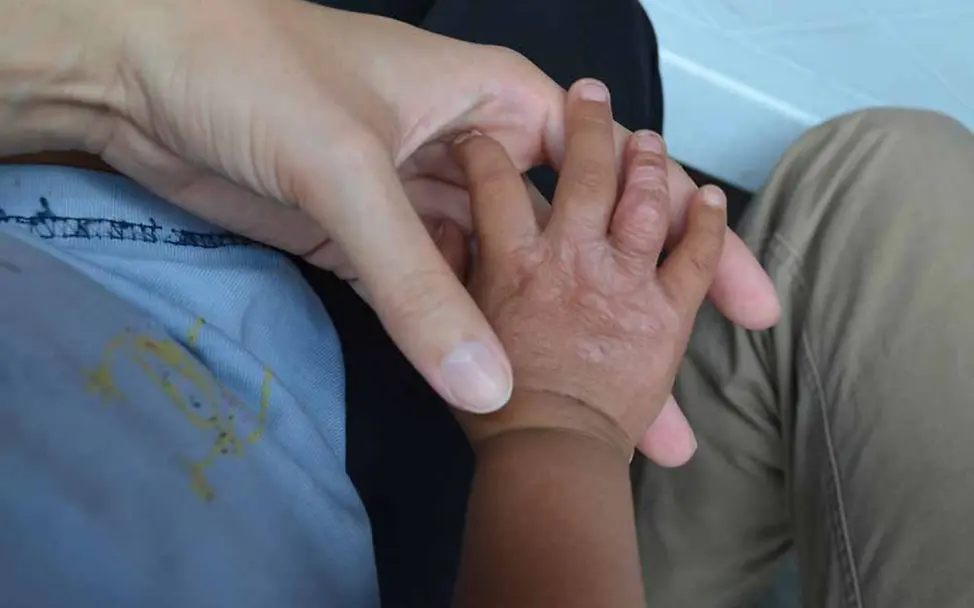 Manche Dinge möchte ich gar nicht wissen. Zum Beispiel, wie sich dieses Baby die halbe Hand verbrannt hat… | © UNICEF/Mäusbacher Philippinen Kinderschutz