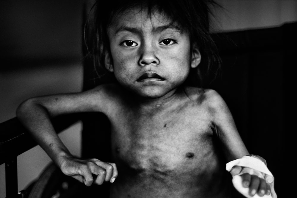 Guatemala: Marked by malnutrition