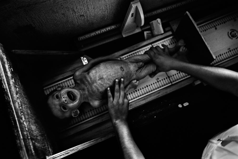 Guatemala: Marked by malnutrition | ©JM Lopez/Freelance Photographer Guatemala: Marked by malnutrition