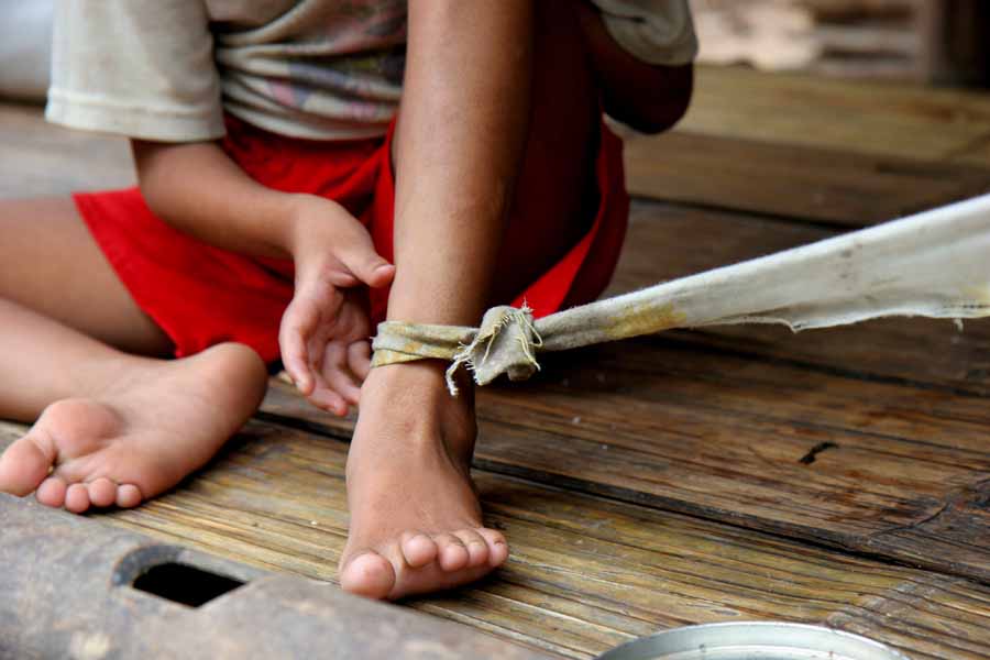 Thailand: Ein Kind mit einer Fußfessel aus Stoff.
