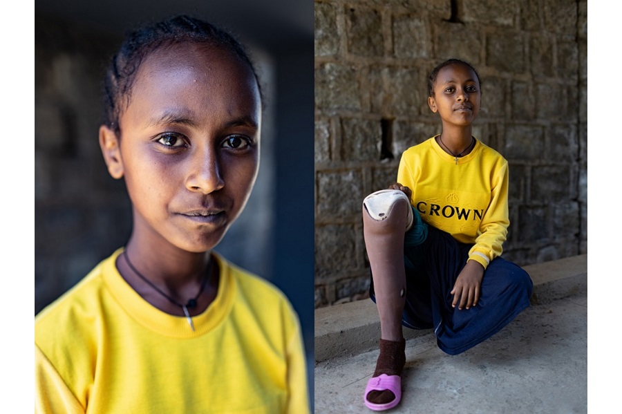 Philippines, Ethiopia, Haiti: Bringing mobility to children with limb loss