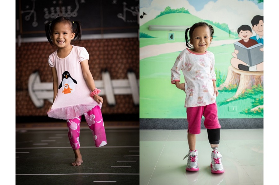 Philippines, Ethiopia, Haiti: Bringing mobility to children with limb loss