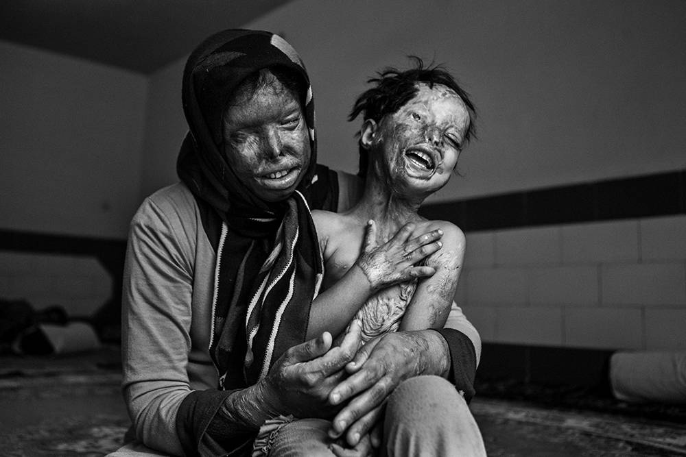 Säureopfer Iran. © Younes Khani/Mehr News Agency Säureopfer Iran. © Younes Khani/Mehr News Agency