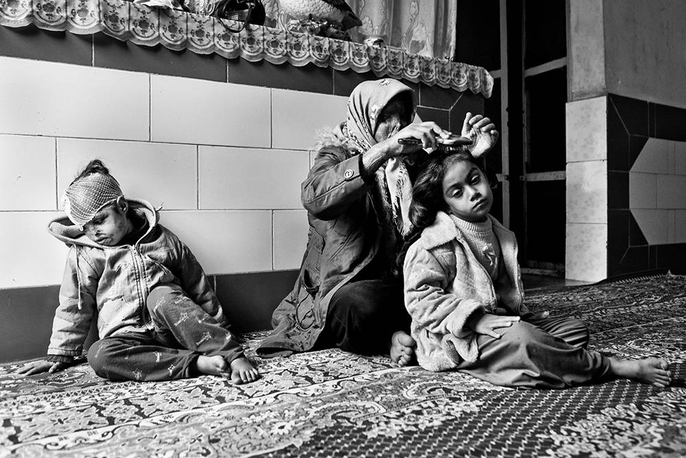 Säureopfer Iran. © Younes Khani/Mehr News Agency Säureopfer Iran. © Younes Khani/Mehr News Agency
