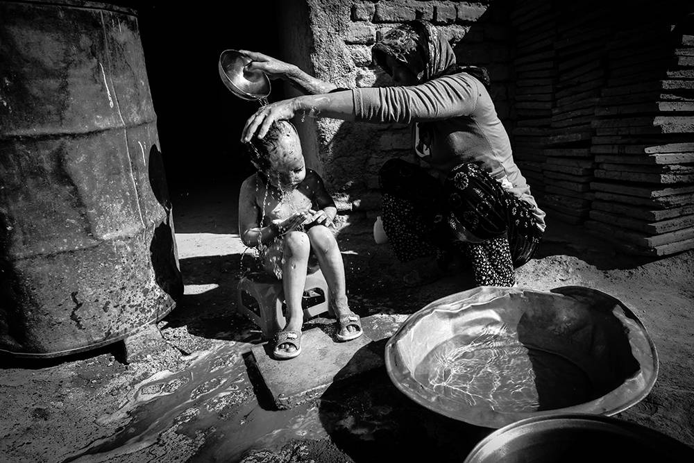 Säureopfer Iran. © Younes Khani/Mehr News Agency Säureopfer Iran. © Younes Khani/Mehr News Agency