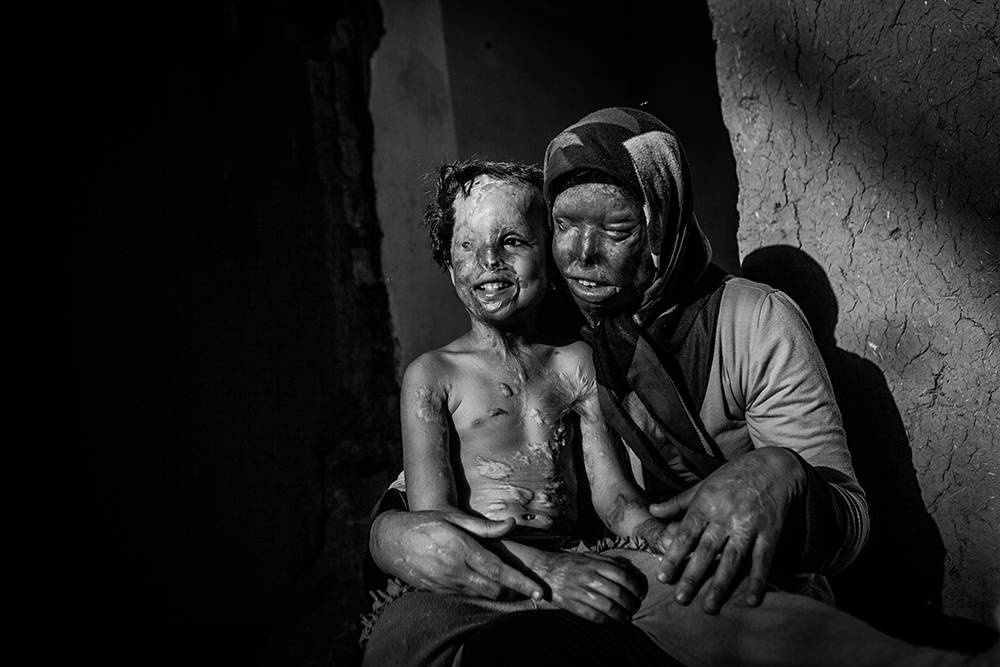 Säureopfer Iran. © Younes Khani/Mehr News Agency Säureopfer Iran. © Younes Khani/Mehr News Agency