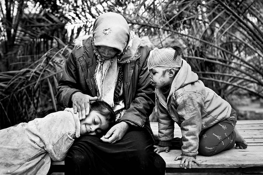 Säureopfer Iran. © Younes Khani/Mehr News Agency Säureopfer Iran. © Younes Khani/Mehr News Agency