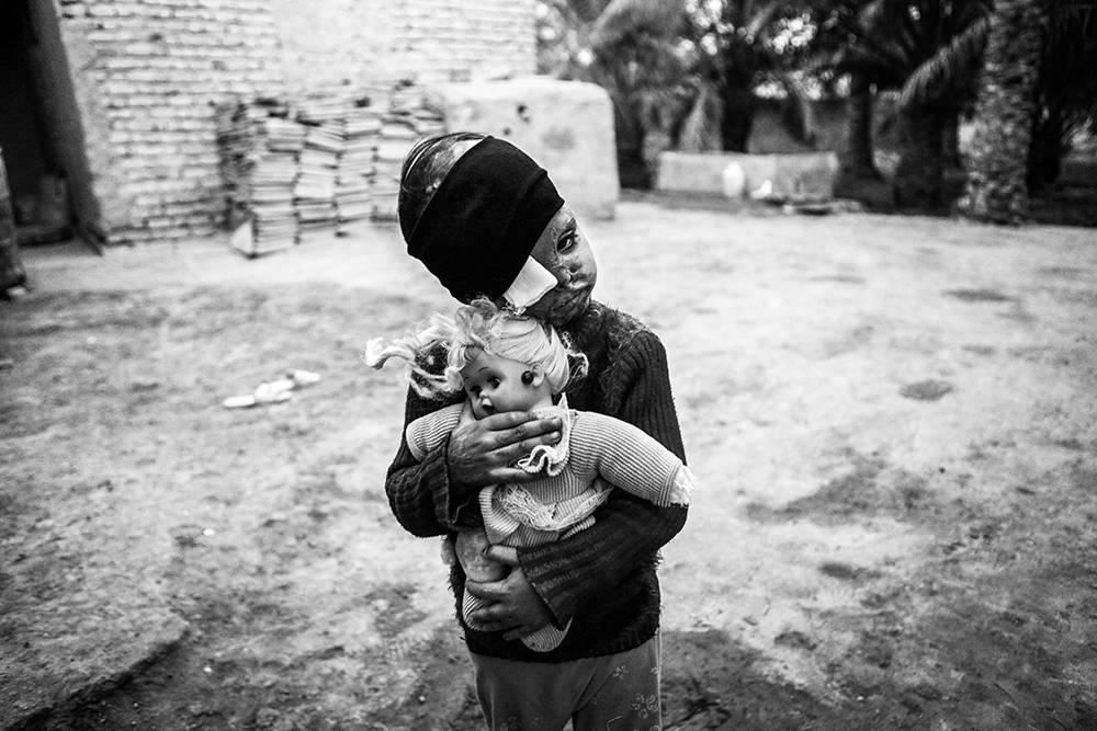 Säureopfer Iran. © Younes Khani/Mehr News Agency Säureopfer Iran. © Younes Khani/Mehr News Agency