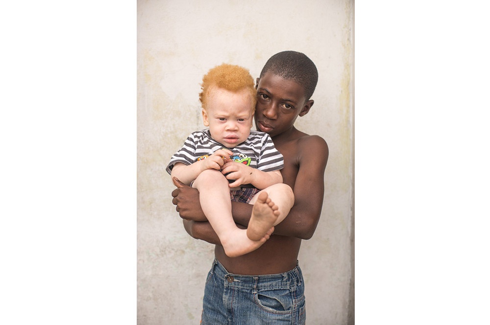 Kongo: Albinismus - White Ebony | © Patricia Willocq/Corbis Images Kongo: Albinismus - White Ebony | © Patricia Willocq/Corbis Images