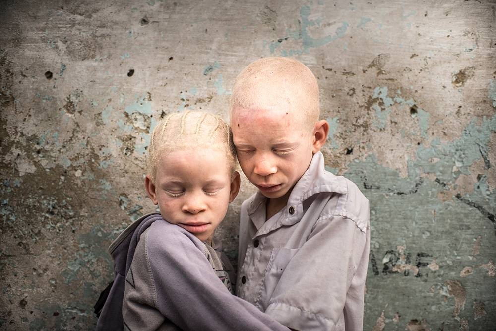 Kongo: Albinismus - White Ebony | © Patricia Willocq/Corbis Images