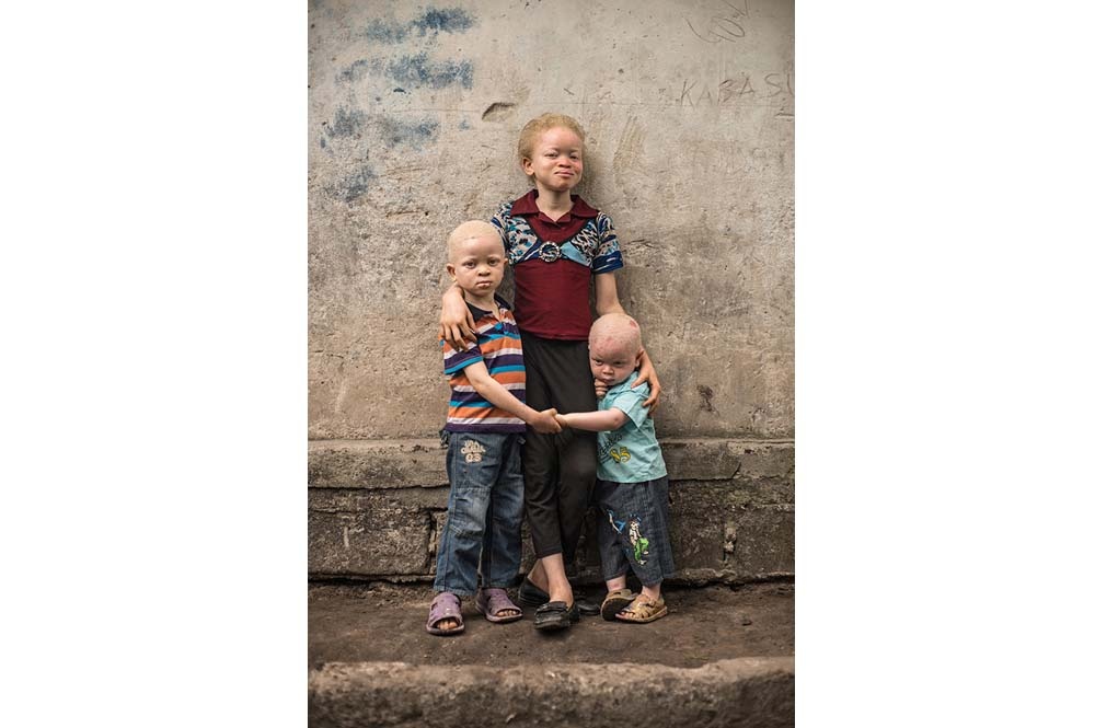 Kongo: Albinismus - White Ebony | © Patricia Willocq/Corbis Images