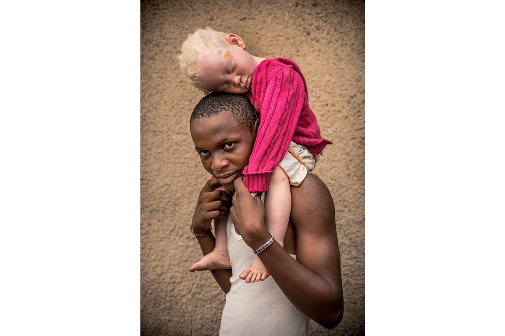 Kongo: Albinismus - White Ebony | © Patricia Willocq/Corbis Images Kongo: Albinismus - White Ebony | © Patricia Willocq/Corbis Images