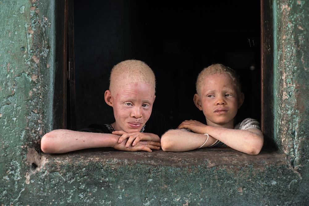Congo: Albinism - White Ebony | © Patricia Willocq/Corbis Images Congo: Albinism - White Ebony | © Patricia Willocq/Corbis Images
