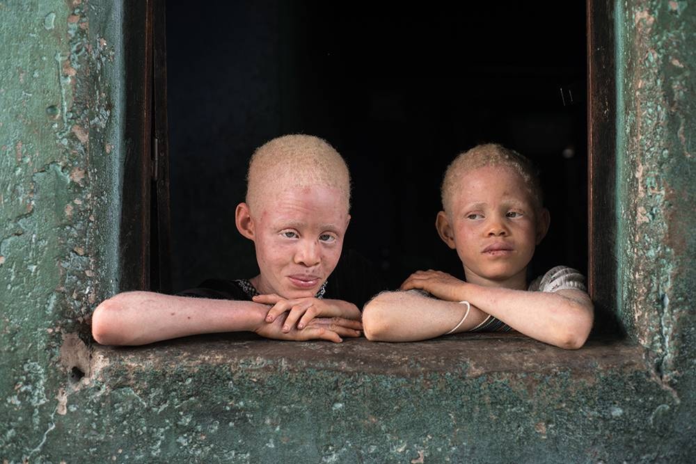 Congo: Albinism - White Ebony | © Patricia Willocq/Corbis Images