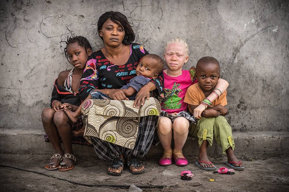 Congo: Albinism - White Ebony | © Patricia Willocq/Corbis Images