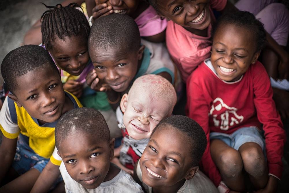 Congo: Albinism - White Ebony | © Patricia Willocq/Corbis Images