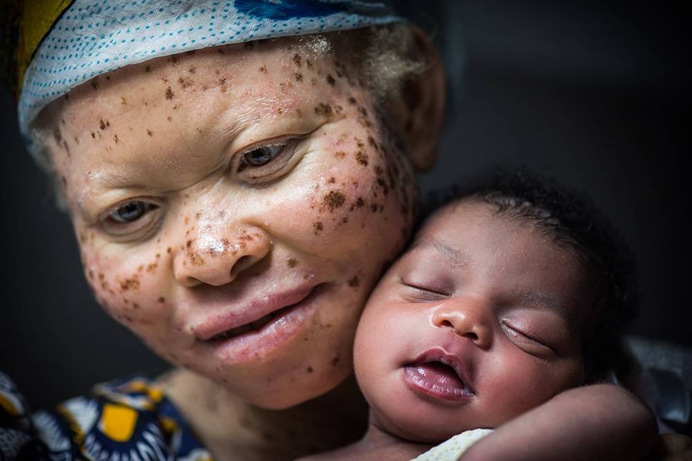 Congo: Albinism - White Ebony | © Patricia Willocq/Corbis Images Congo: Albinism - White Ebony | © Patricia Willocq/Corbis Images