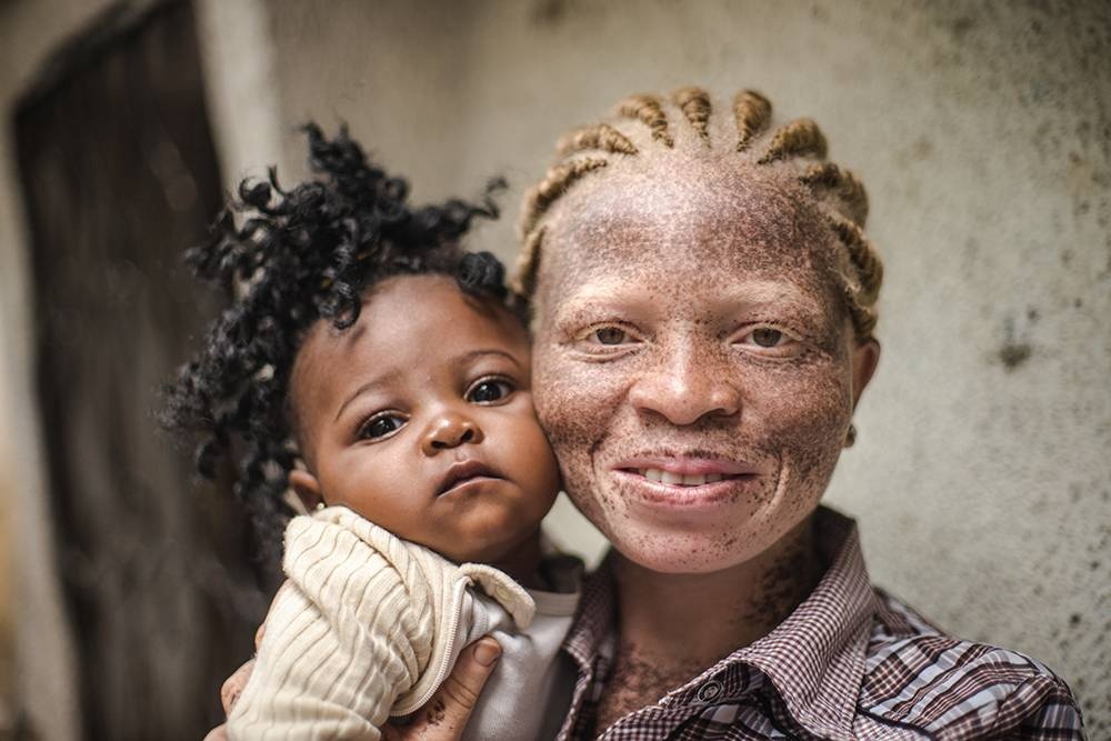 Congo: Albinism - White Ebony | © Patricia Willocq/Corbis Images Congo: Albinism - White Ebony | © Patricia Willocq/Corbis Images