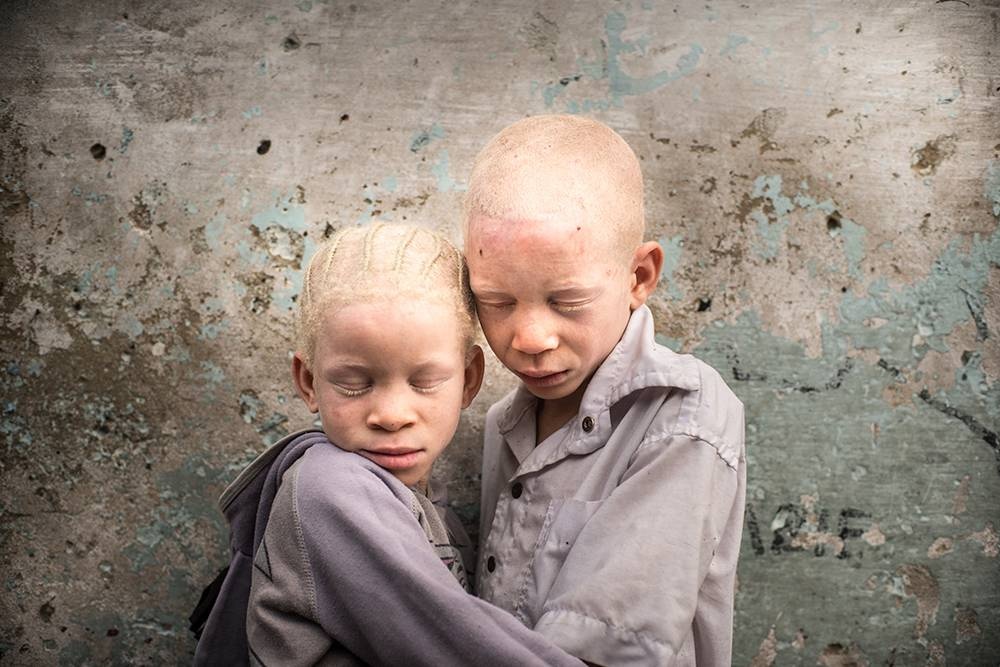 Congo: Albinism - White Ebony | © Patricia Willocq/Corbis Images