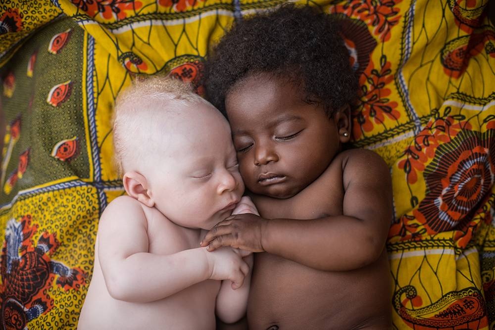Congo: Albinism - White Ebony | © Patricia Willocq/Corbis Images