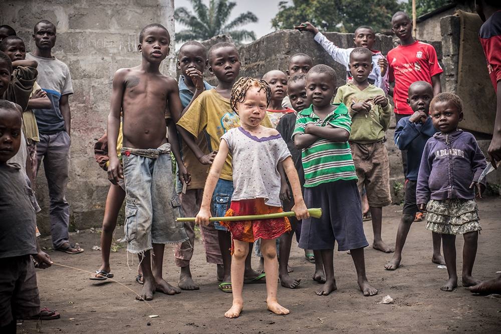 Congo: Albinism - White Ebony | © Patricia Willocq/Corbis Images