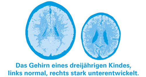Entwicklung eines Gehirns bei Mangelernährung | © UNICEF DT Mangelernährung: Entwicklung eines Gehirns