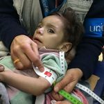 Syrie-Krieg: Schwer mangelernährtes Mädchen in Madaya