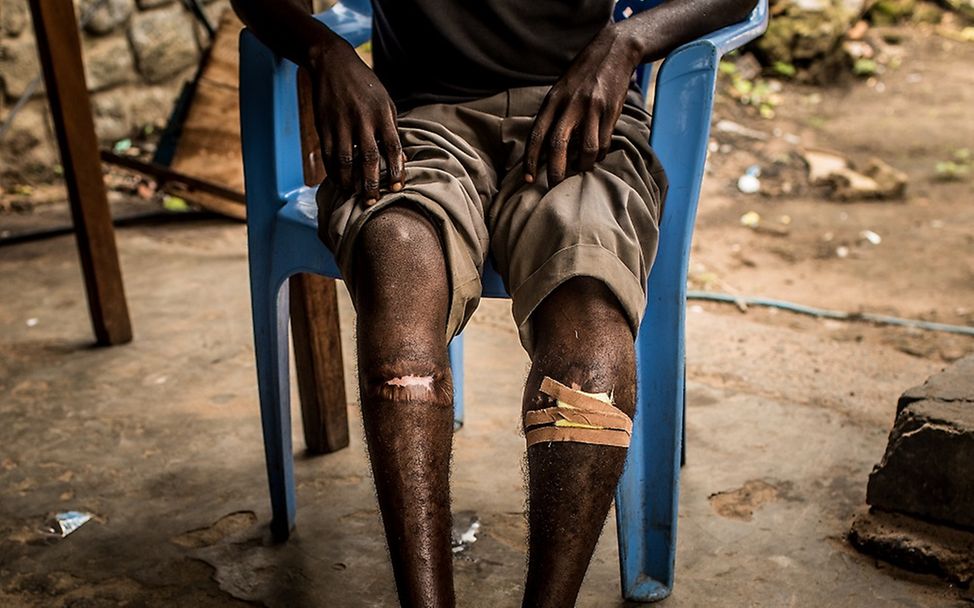 Kongo: Albert zeigt seine Wunden die er als Kindersoldat erlitten hat.