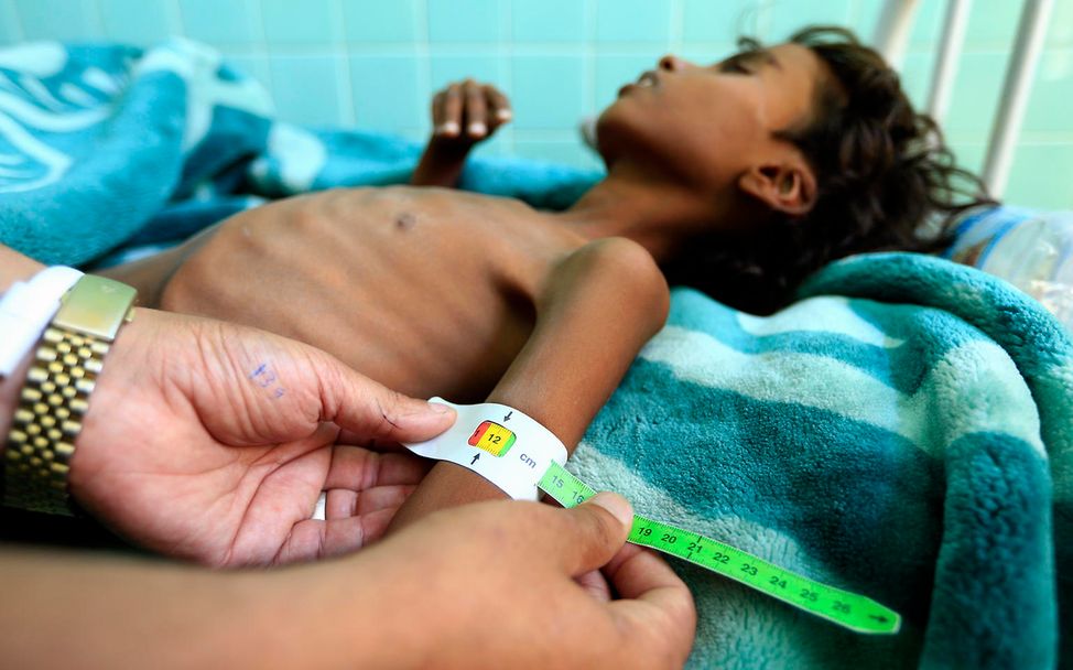 Drohende Hungersnot im Jemen: Der mangelernährte Ali wird im Krankenhaus behandelt.