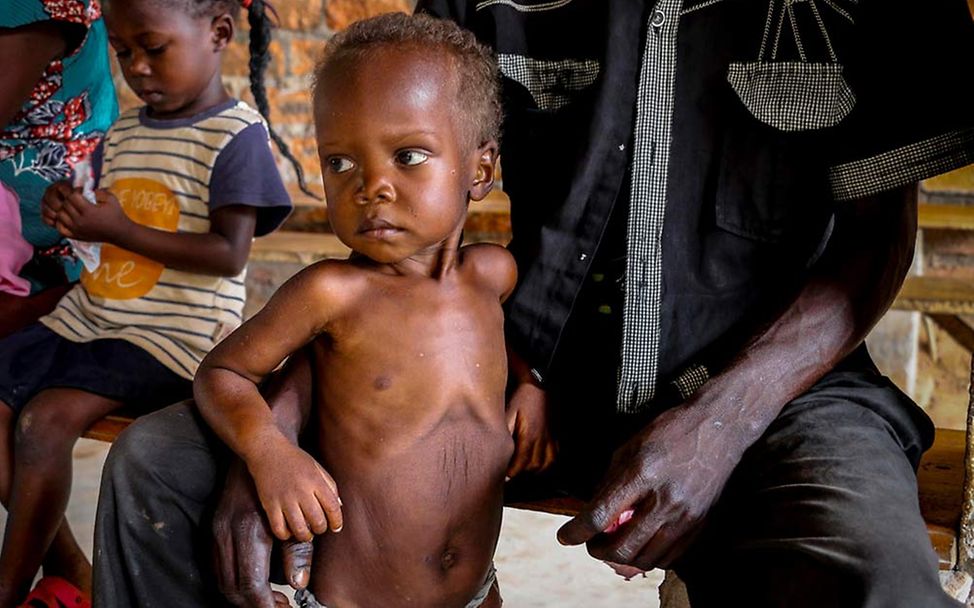 Mangelernährung in der Zentralafrikanischen Republik 