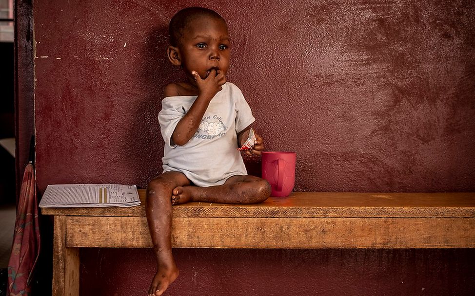 Ein mangelernährtes Kind in einem Kinder-Krankenhaus in Bangui. 