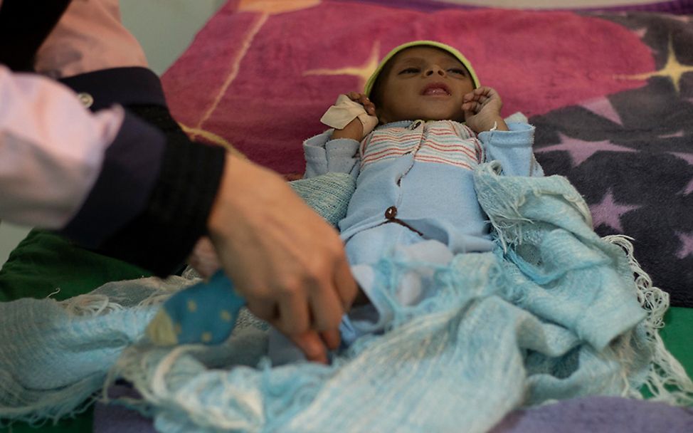 Jemen: Ein mangelernährtes Baby wird auf der Station für therapeutische Ernährung behandelt.